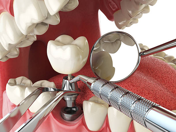 Best Chipped Tooth Repair Near Me  in Westmorland, CA